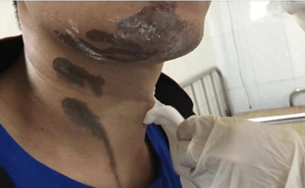 Bỏng nặng do nước tẩy rửa