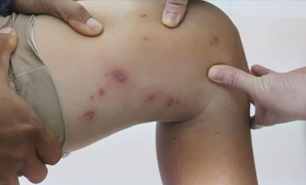 How to properly handle rove beetles' stings ?